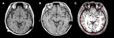 Characteristics of Globus Pallidus Internus Local Field Potentials in Hyperkinetic Disease